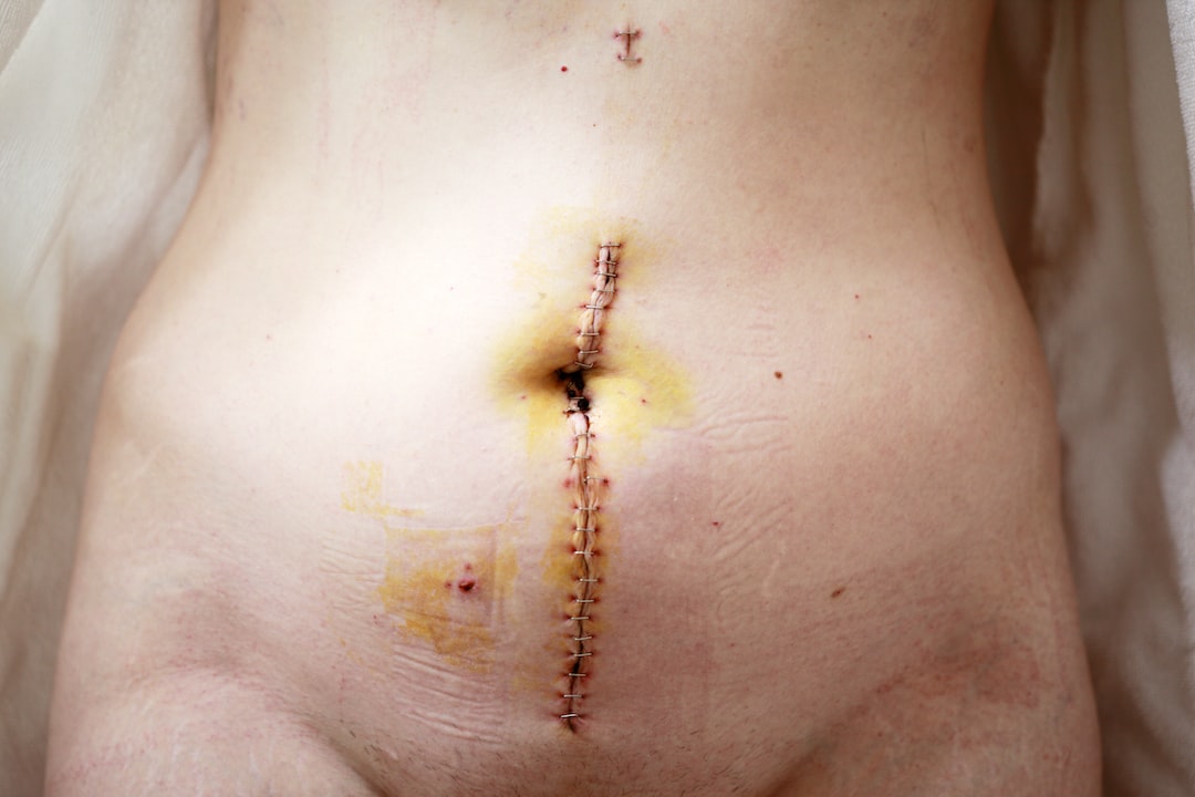 Mini Tummy Tuck Operasyonu Nedir?