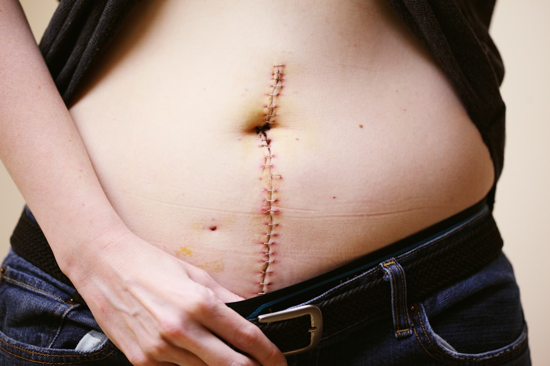 Tam Abdominoplasti Operasyonu İyileşme Süreci ve Bakım Önerileri