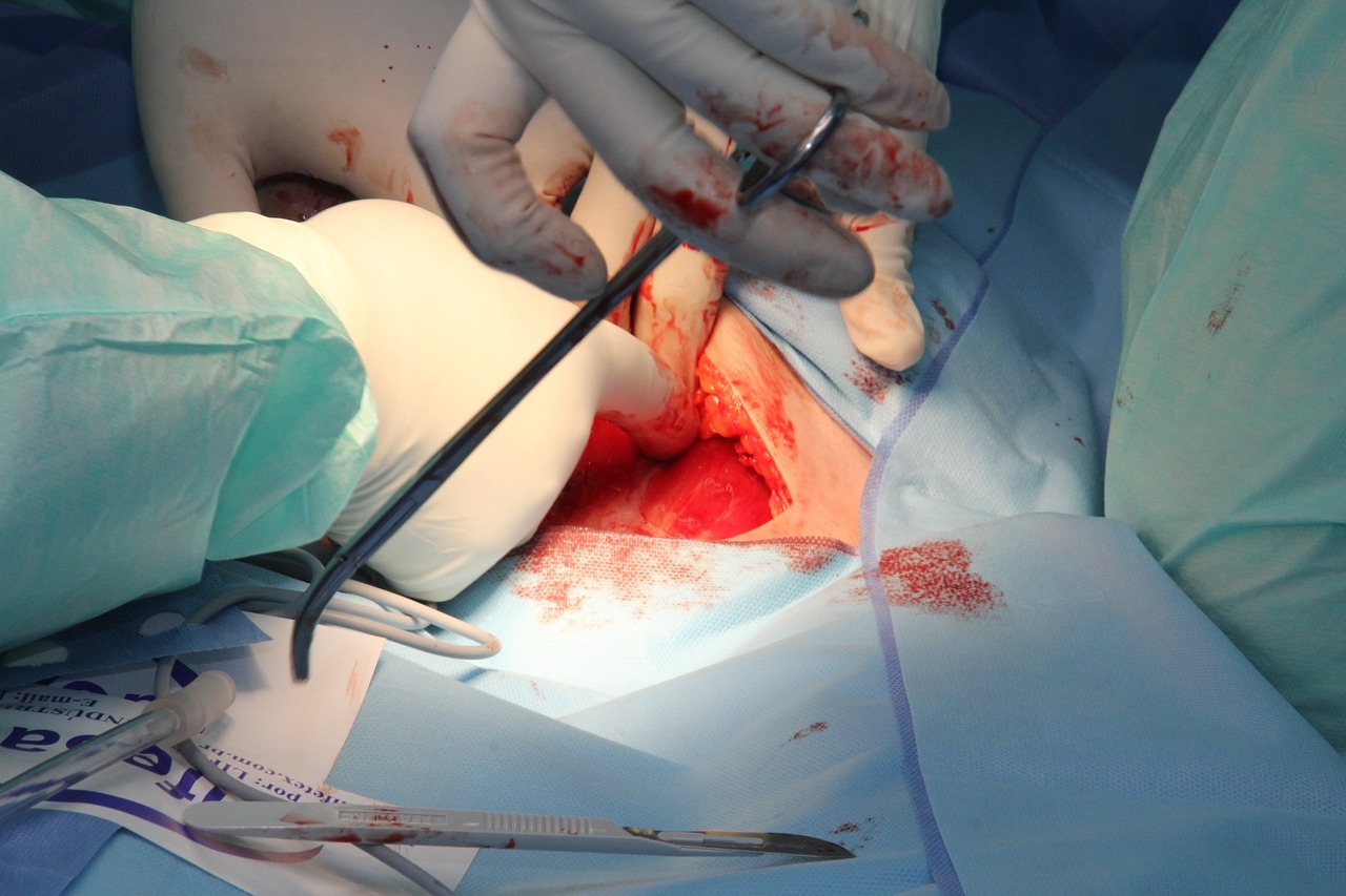 Liposuction ile Bel Bölgesindeki Fazla Yağlardan Kurtulmanın Yolları