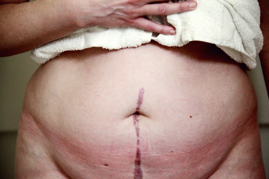 Liposuction Sonrası İyileşme Sürecinde Nelere Dikkat Etmelisiniz?