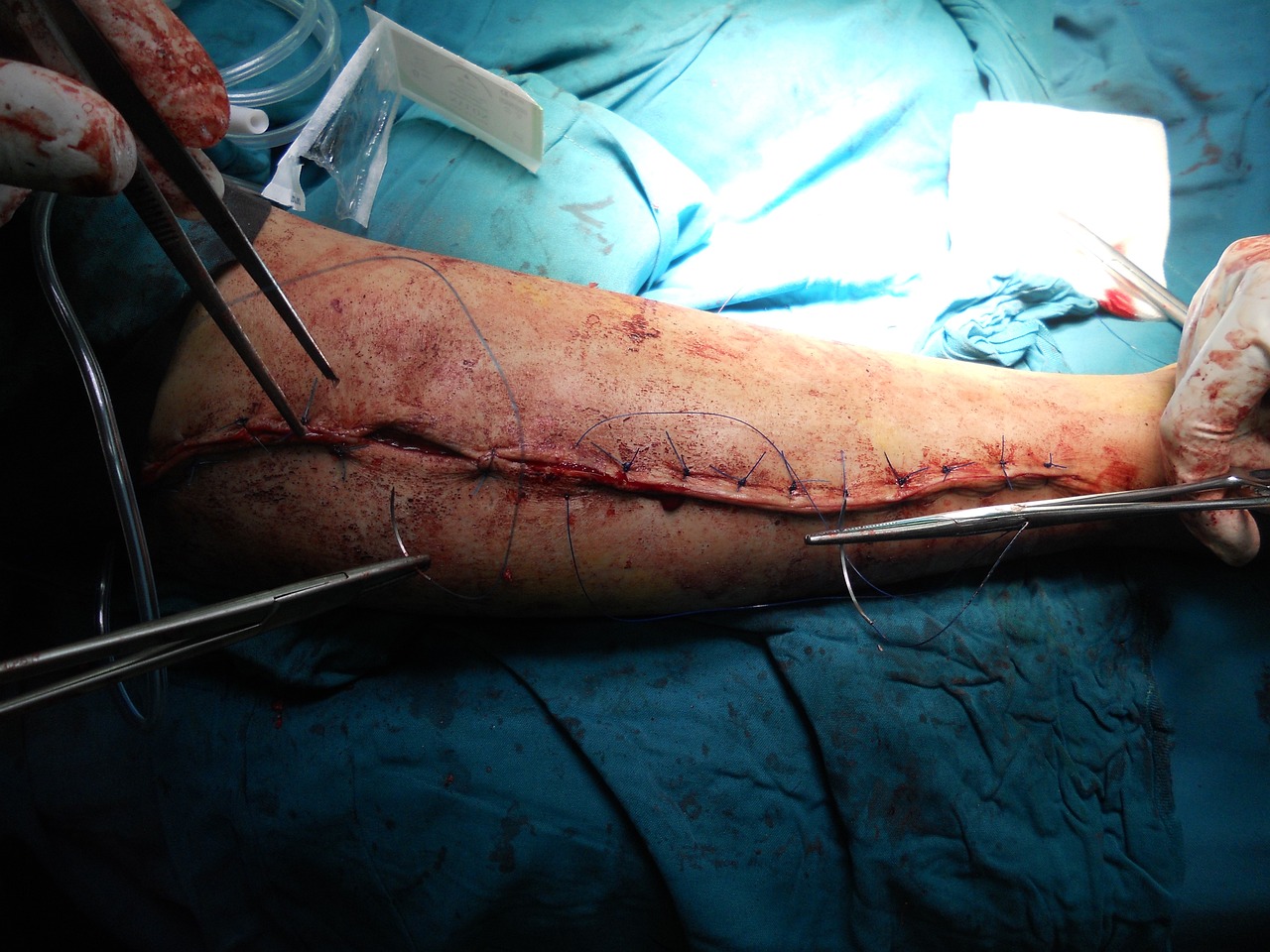 Vaser Liposuction Ameliyat Öncesi Hazırlık Süreci