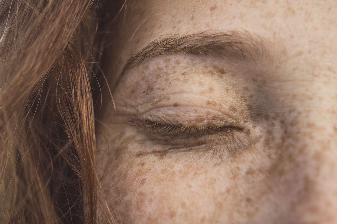 Kimyasal Peeling Nedir?