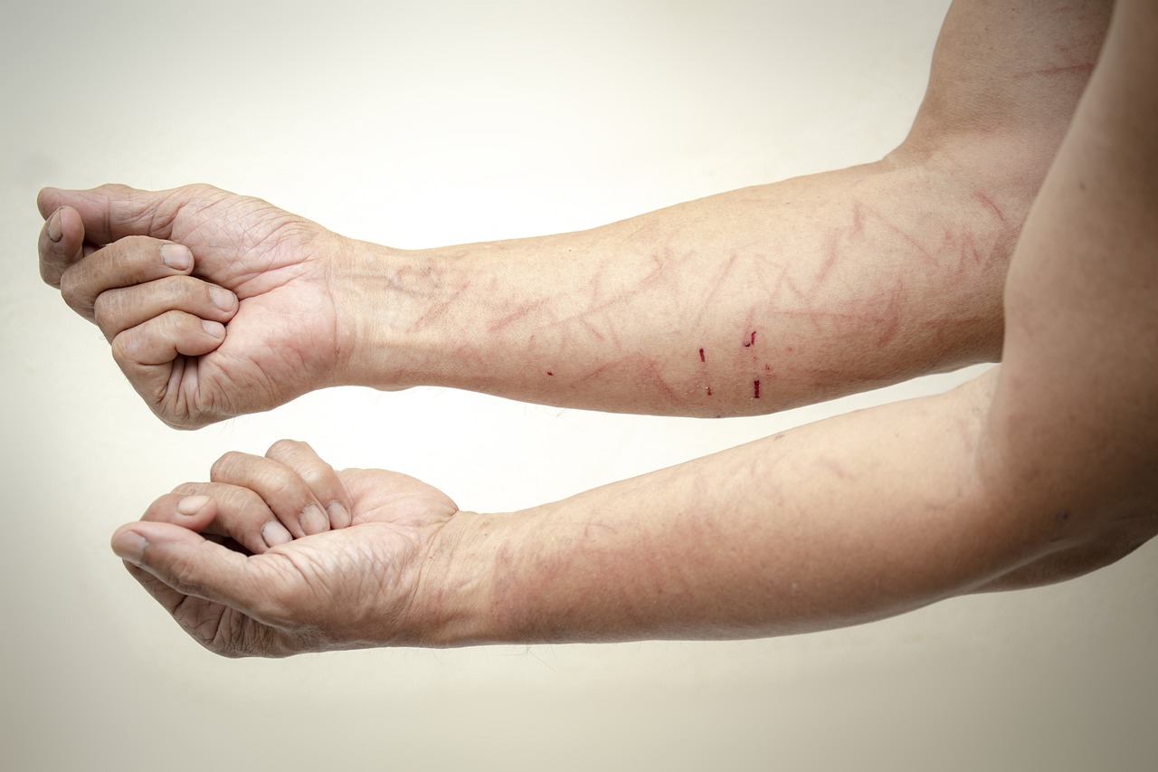 Platelet Zengin Plazma Nedir?