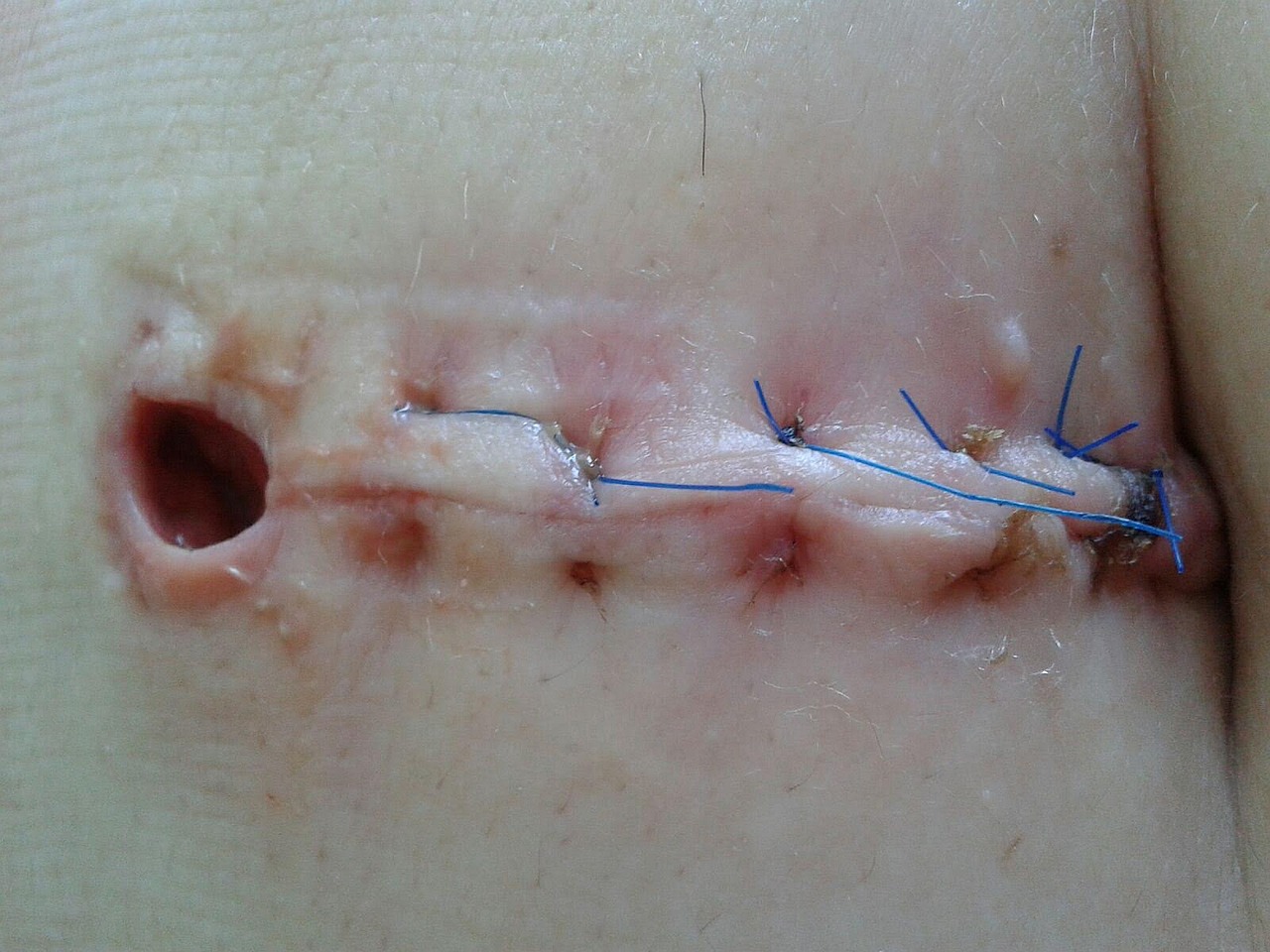 Sırt Liposuctionu ve Estetik Fazla Yağlardan Kurtulmanın Etkili Yolları